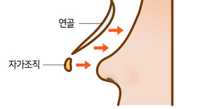 매부리코성형 수술 단면 일러스트