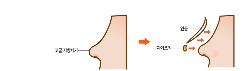 넓은코성형 수술 단면 일러스트