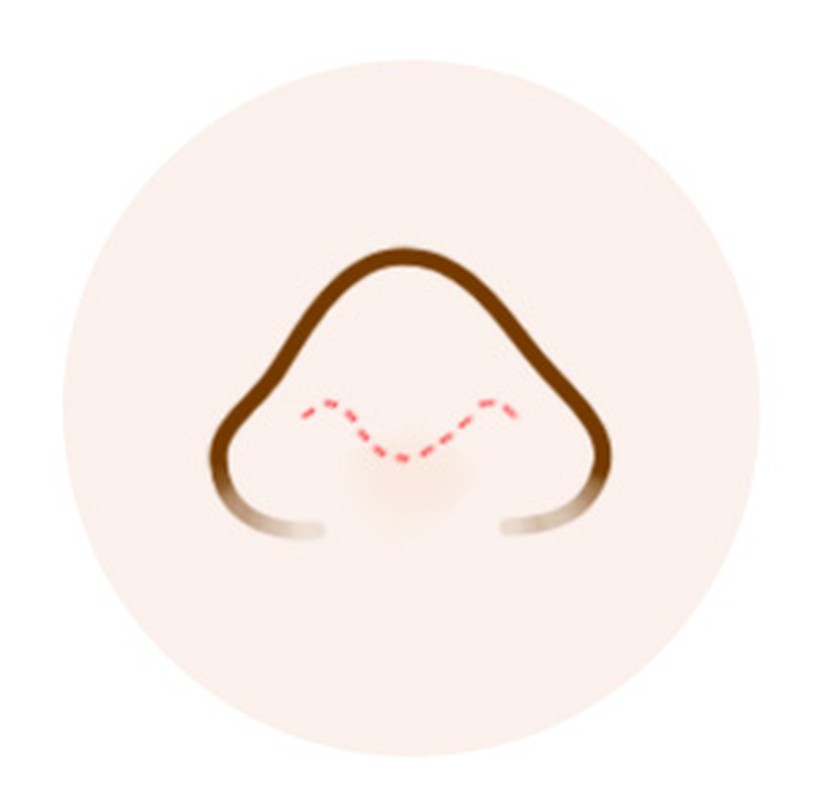 절개 수술 일러스트