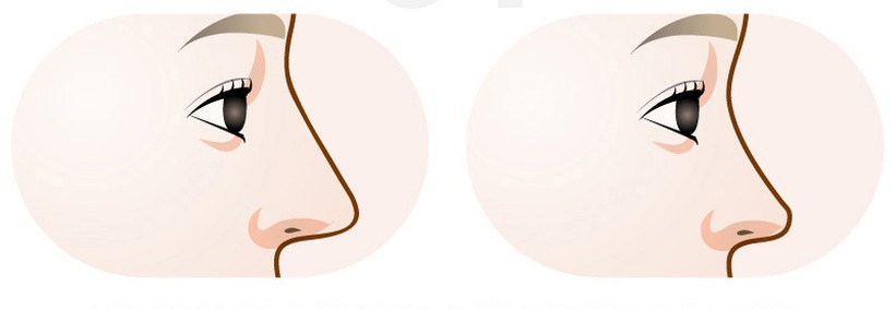 코가 너무 높아 어색한 경우 수술 일러스트